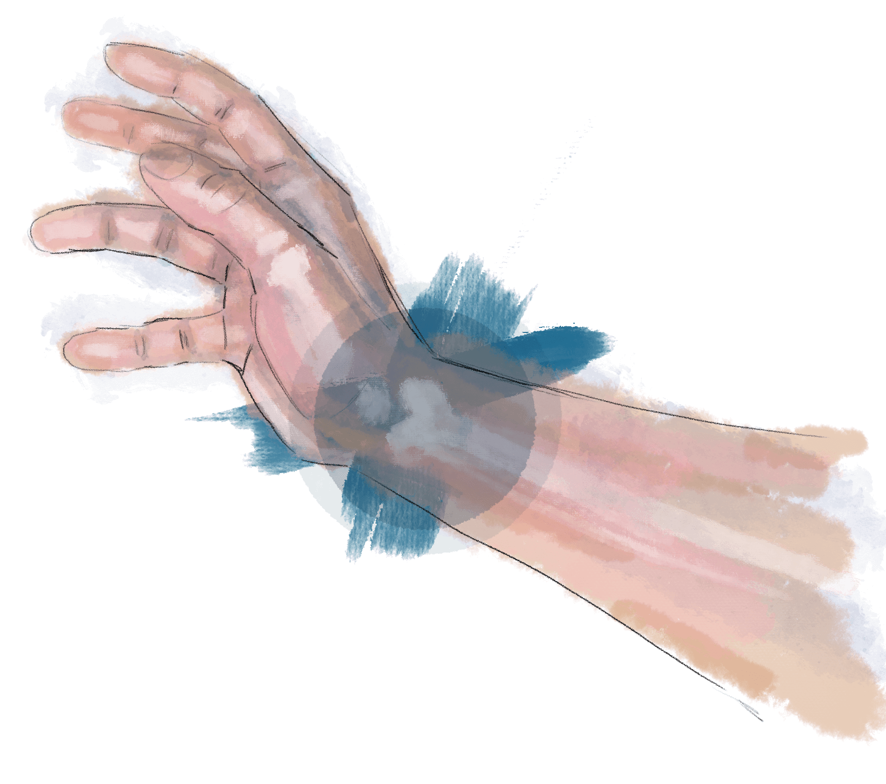 Displaced distal radius fractures